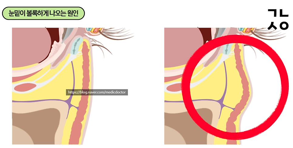 Diagram explaining Lower Blepharoplasty