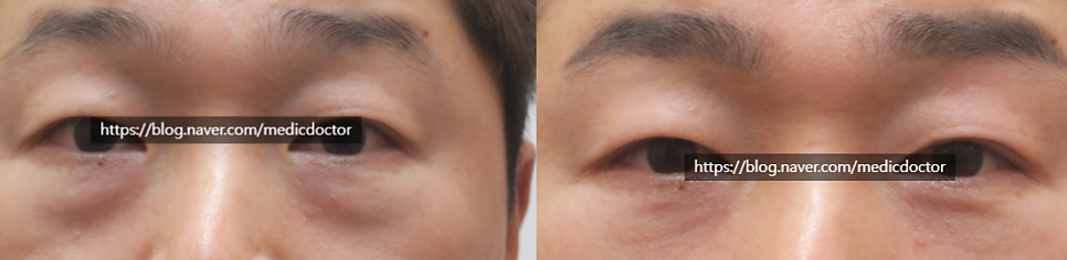 Eye photo from a Lower Blepharoplasty case