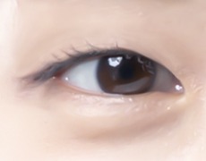 절개 눈매교정 STEP 01