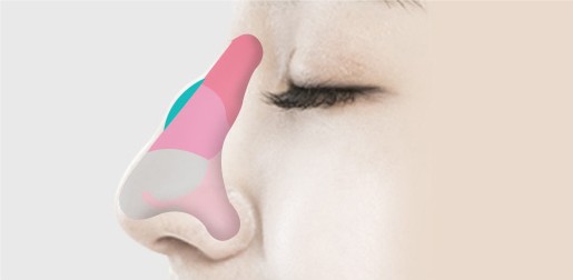 매부리코 성형(증상 심함) STEP 02 — 절골