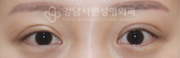 퇴축수술 수술 전