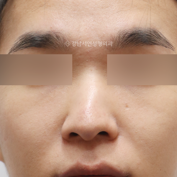 무보형물 코성형 BEFORE