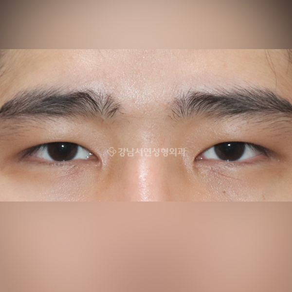 절개눈매교정+앞트임 AFTER