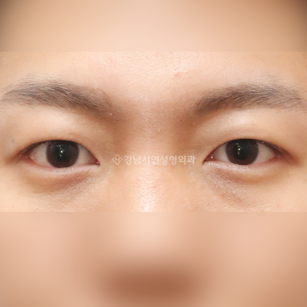 절개눈매교정 AFTER