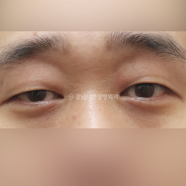 절개눈매교정 BEFORE