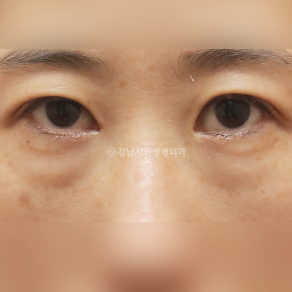 눈밑지방재배치 BEFORE