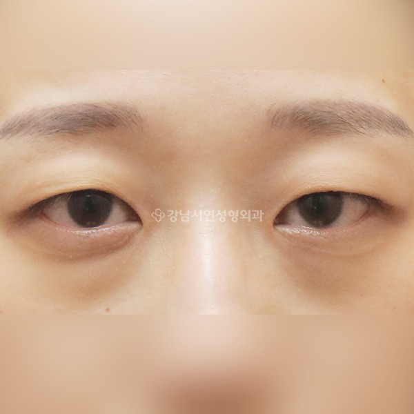절개눈매교정+앞트임+눈밑지방재배치 BEFORE