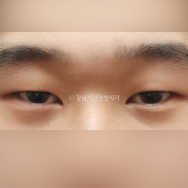 절개눈매교정 BEFORE