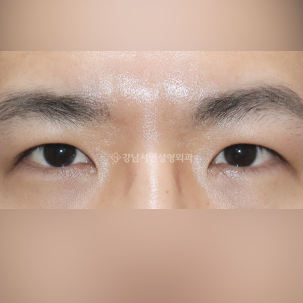절개눈매교정+앞트임 AFTER