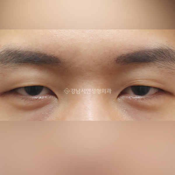 절개눈매교정 BEFORE