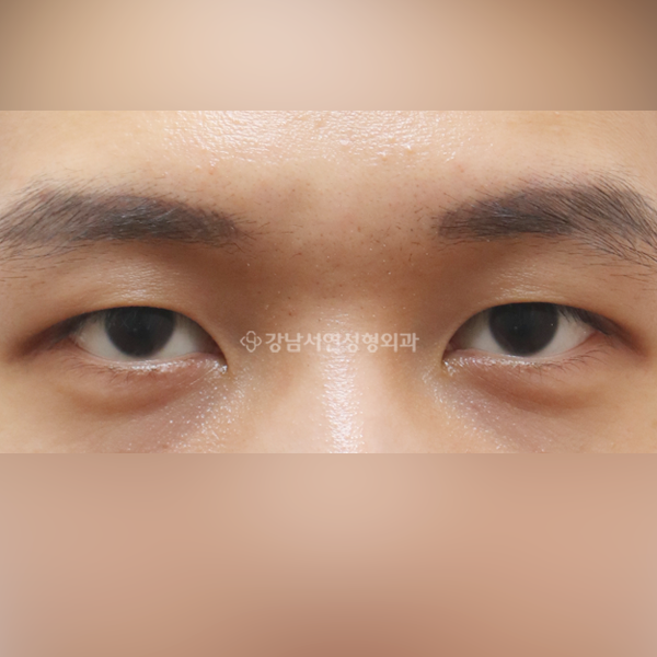 절개눈매교정 AFTER
