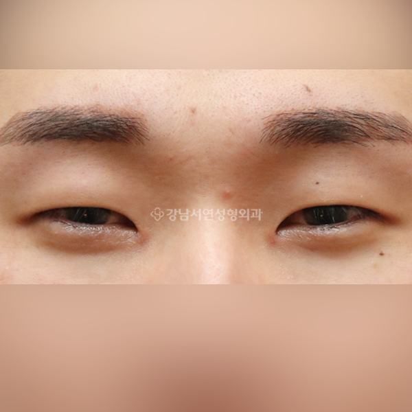 절개눈매교정+앞트임+뒷트임+밑트임 BEFORE