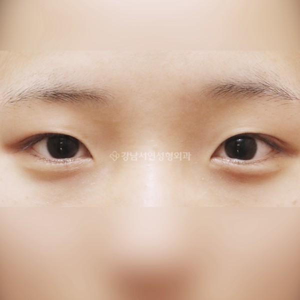 절개눈매교정+앞트임 BEFORE
