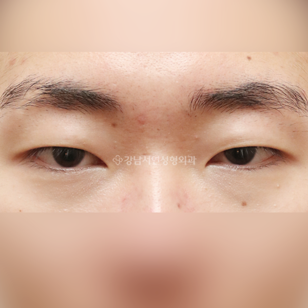 절개눈매교정 BEFORE