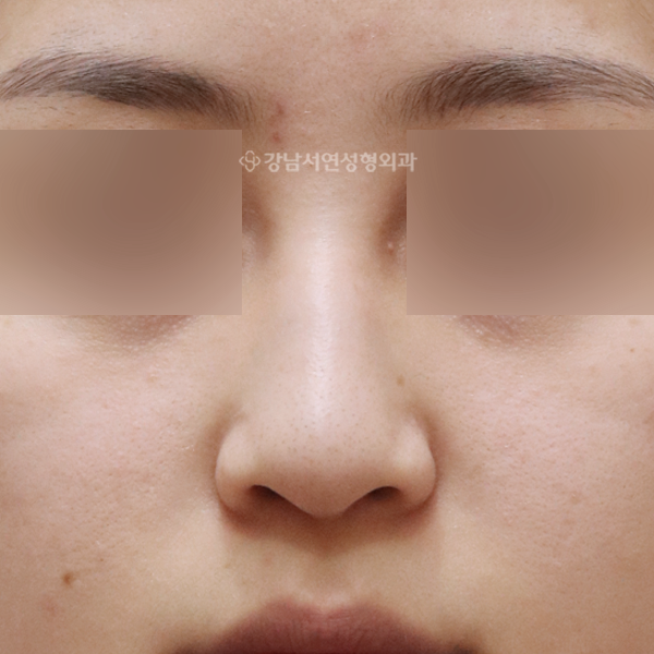 매부리코성형 BEFORE