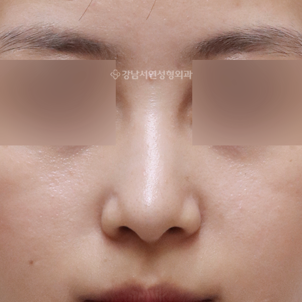 매부리코성형 AFTER