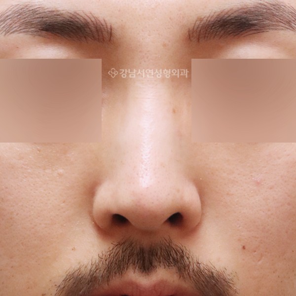 무보형물 코성형 정면 AFTER