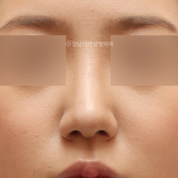 무보형물 코성형 정면 AFTER