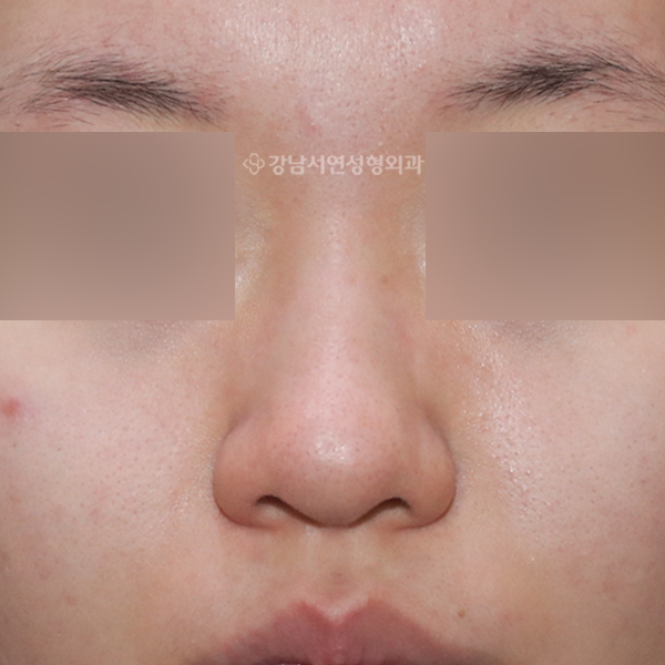 복코 성형 BEFORE