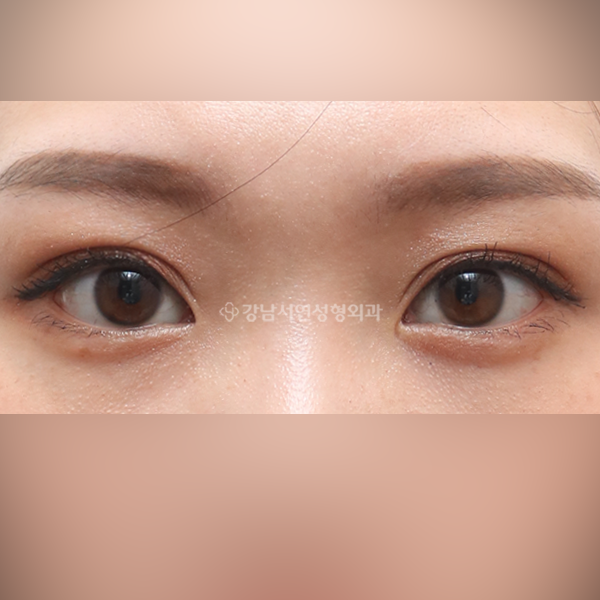 자연유착 쌍꺼풀 AFTER