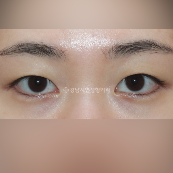 자연유착 쌍꺼풀 BEFORE