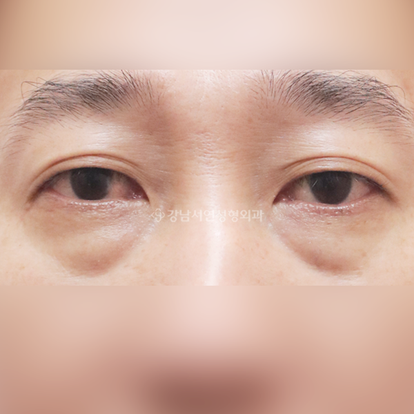 하안검 BEFORE