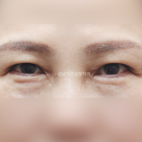상안검 재수술 BEFORE