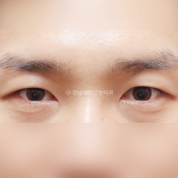 절개눈매교정 앞트임 AFTER