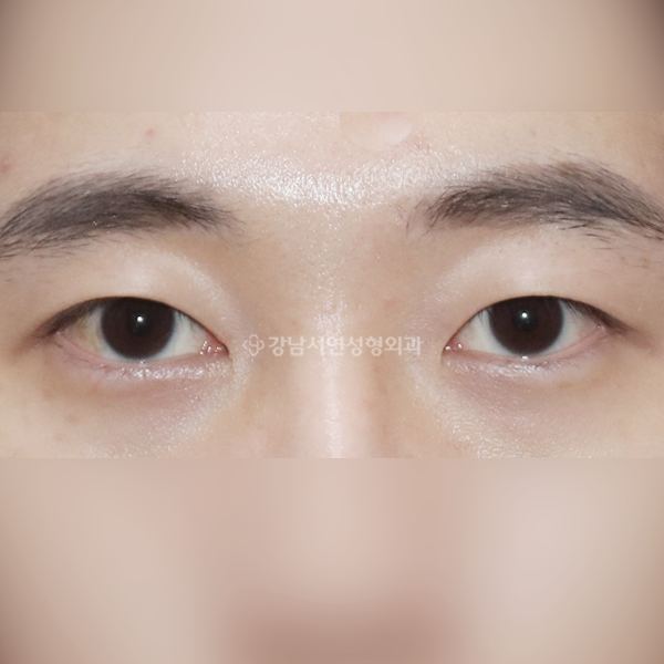 절개눈매교정 앞트임 AFTER