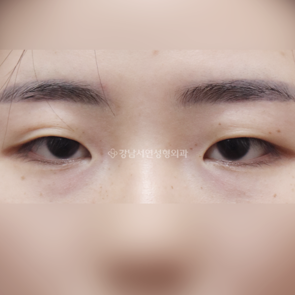 절개눈매교정 앞트임 BEFORE