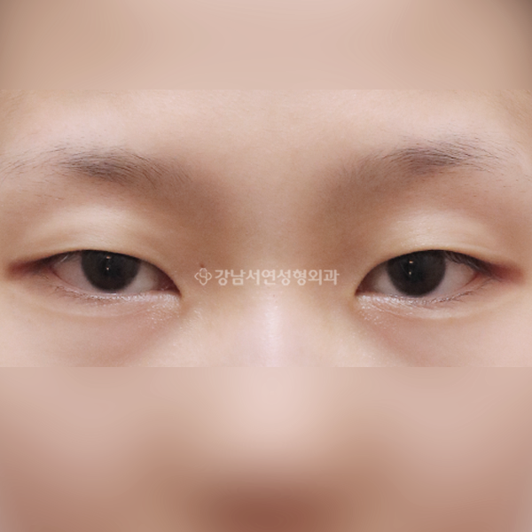 절개눈매교정 앞트임 BEFORE