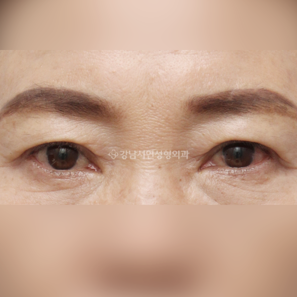 상안검 AFTER
