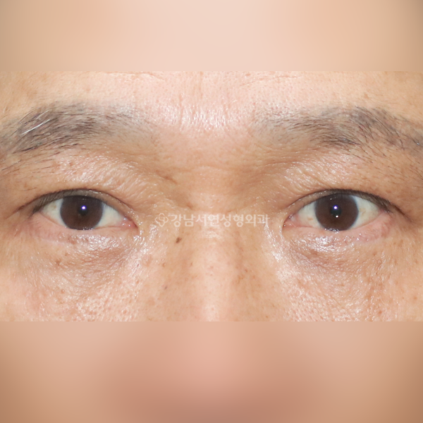 상안검+하안검 AFTER
