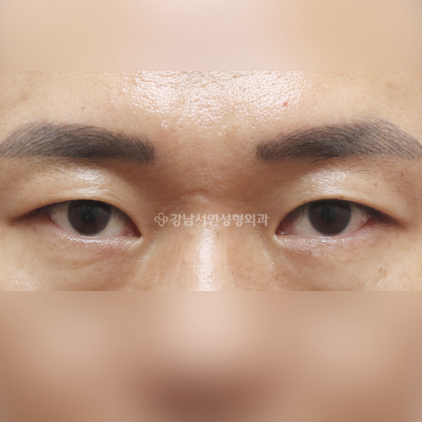 절개눈매교정+앞트임 AFTER