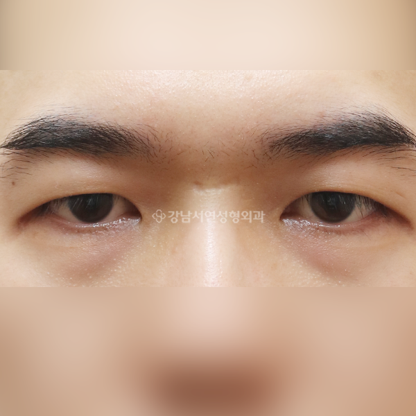 절개눈매교정+앞트임 BEFORE