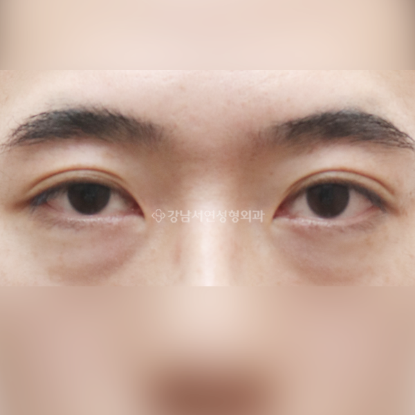 절개눈매교정 BEFORE