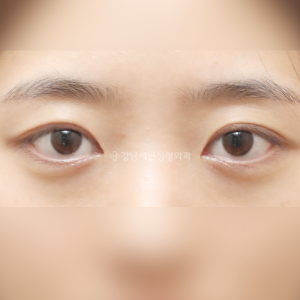절개 쌍꺼풀 재수술 AFTER