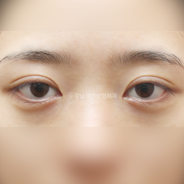 절개 쌍꺼풀 재수술 BEFORE