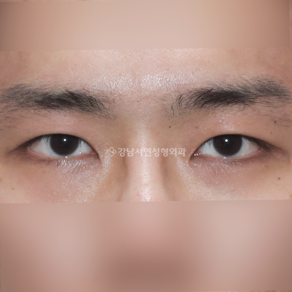 절개눈매교정+앞트임 AFTER