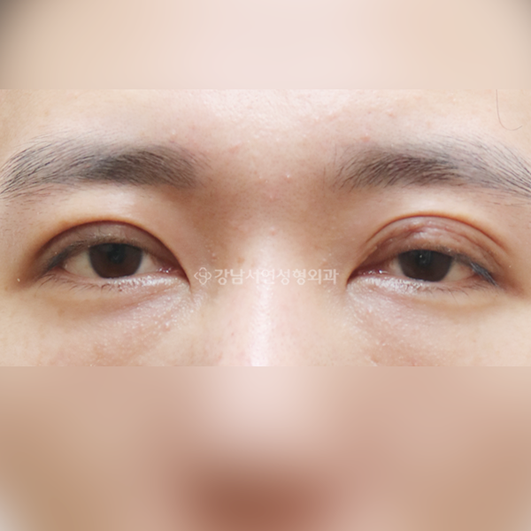 절개 쌍꺼풀 재수술 BEFORE