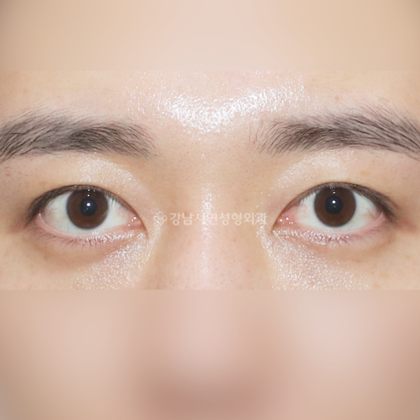 절개 쌍꺼풀 재수술 AFTER