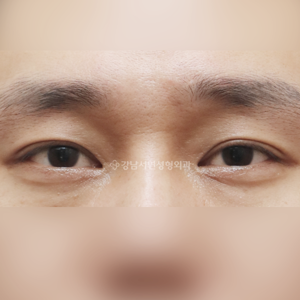 절개 쌍꺼풀 재수술 BEFORE