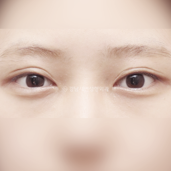 쌍꺼풀 재수술 BEFORE