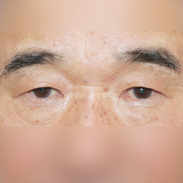 상안검 BEFORE