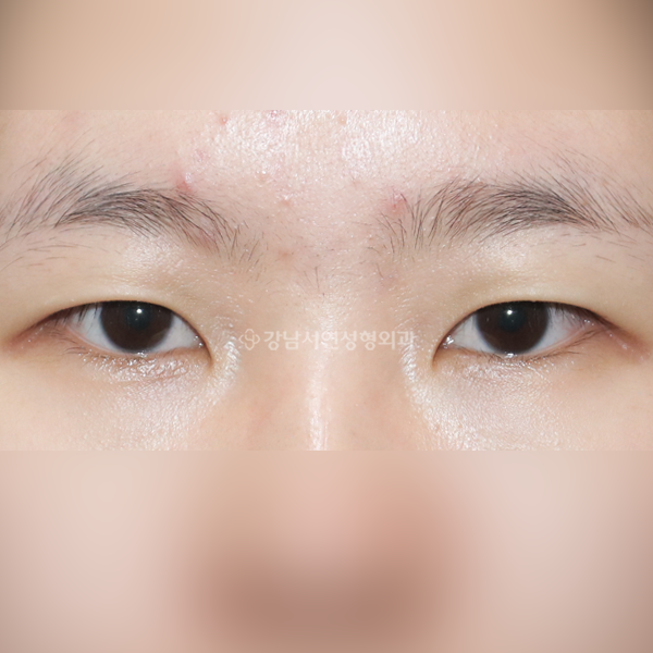 절개눈매교정+앞트임+뒷트임+밑트임 BEFORE