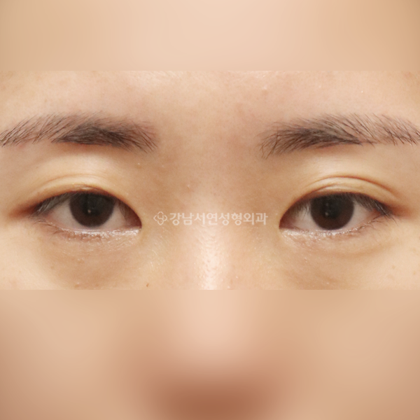 절개눈매교정 BEFORE