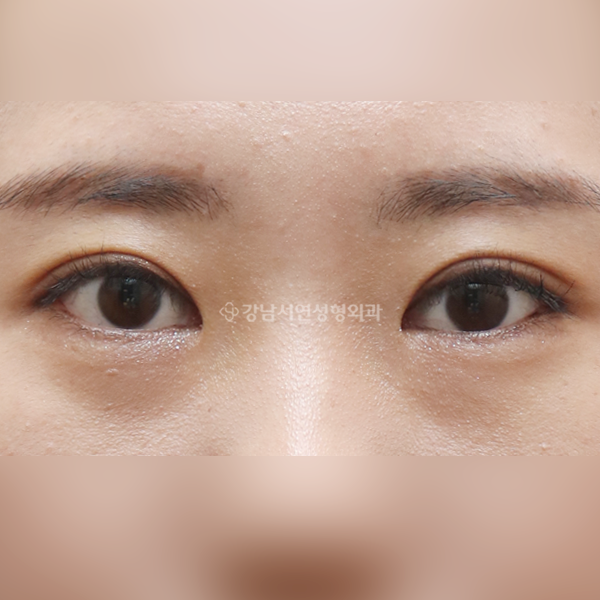 절개눈매교정 AFTER