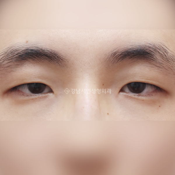 절개눈매교정+앞트임 BEFORE