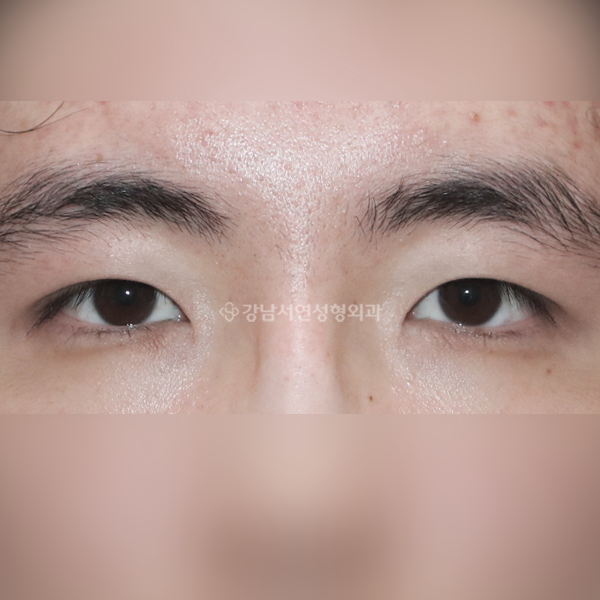 절개눈매교정+앞트임 AFTER
