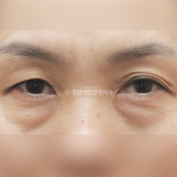 상안검+하안검+앞트임 BEFORE